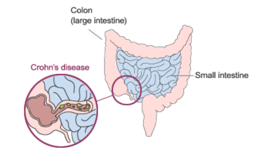 https://www.bonheurmd.com/wp-content/uploads/2019/02/Crohn%E2%80%99s-Disease.png