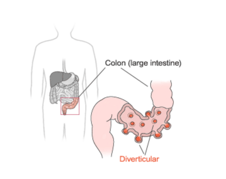 Diverticular Disease