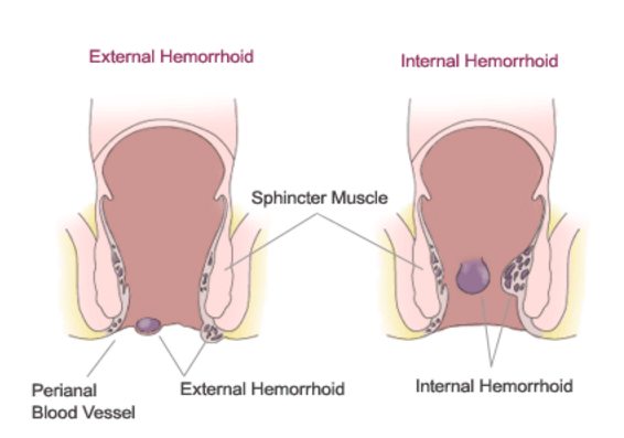 Piles in Men - Problems, Causes, Symptoms and Treatment