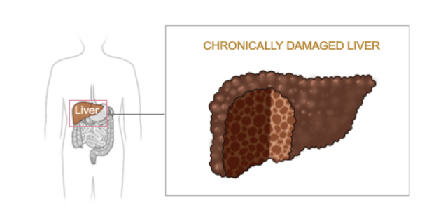 Hepatitis