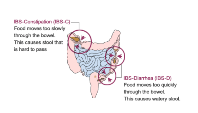 Irritable Bowel Syndrome IBS Gastroenterologist