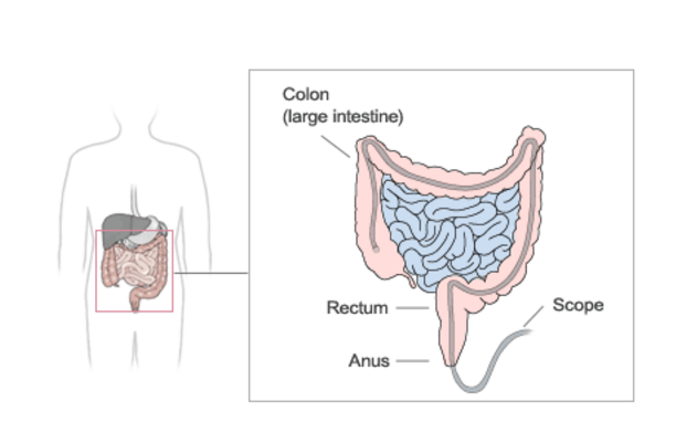 Screening for Colon Cancer