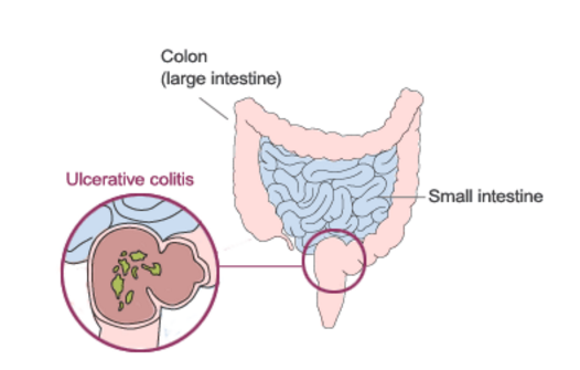 Ulcerative Colitis and Proctitis - Gastroenterologist